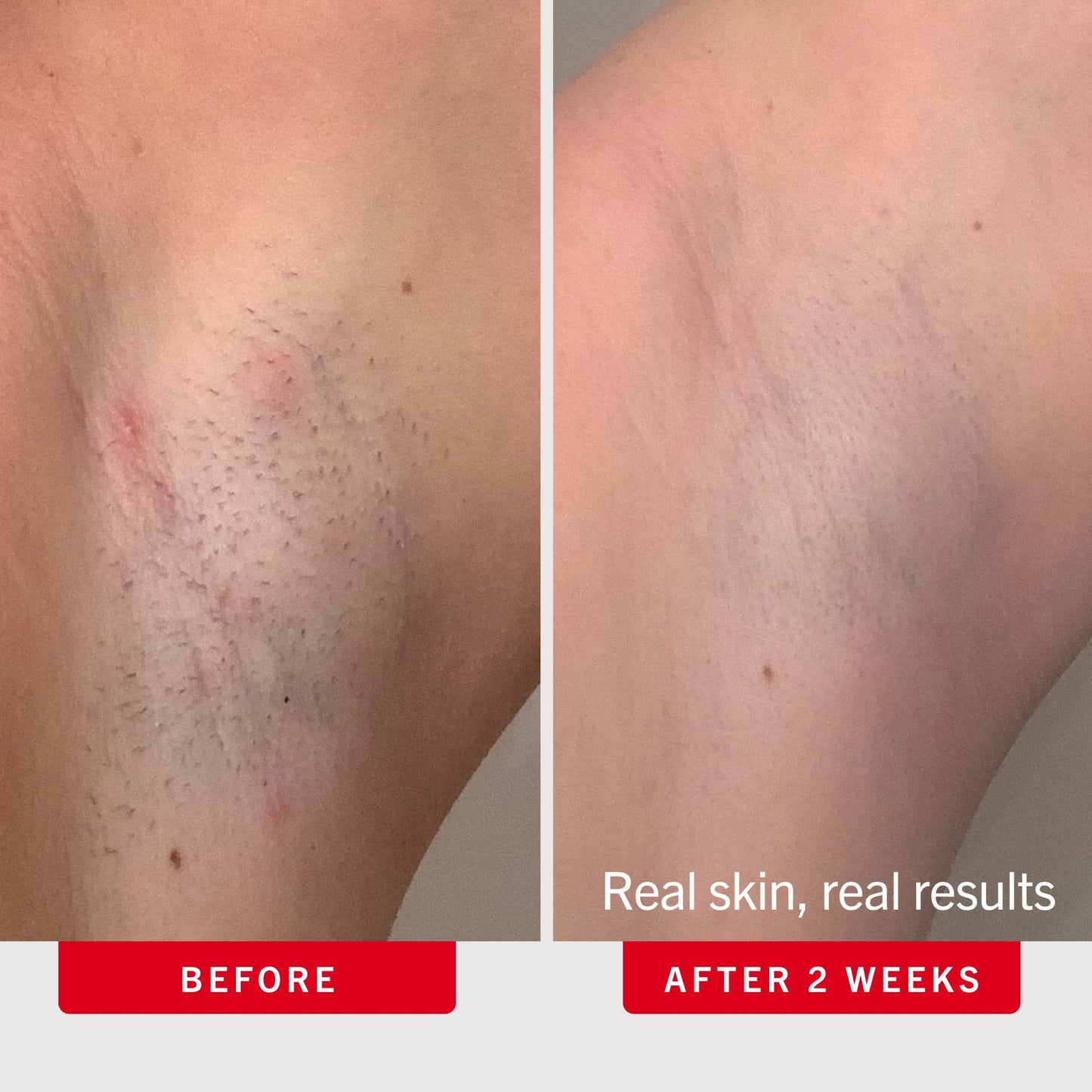 First Aid Beauty Smoothing Body Pads
