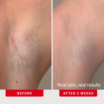 First Aid Beauty Smoothing Body Pads