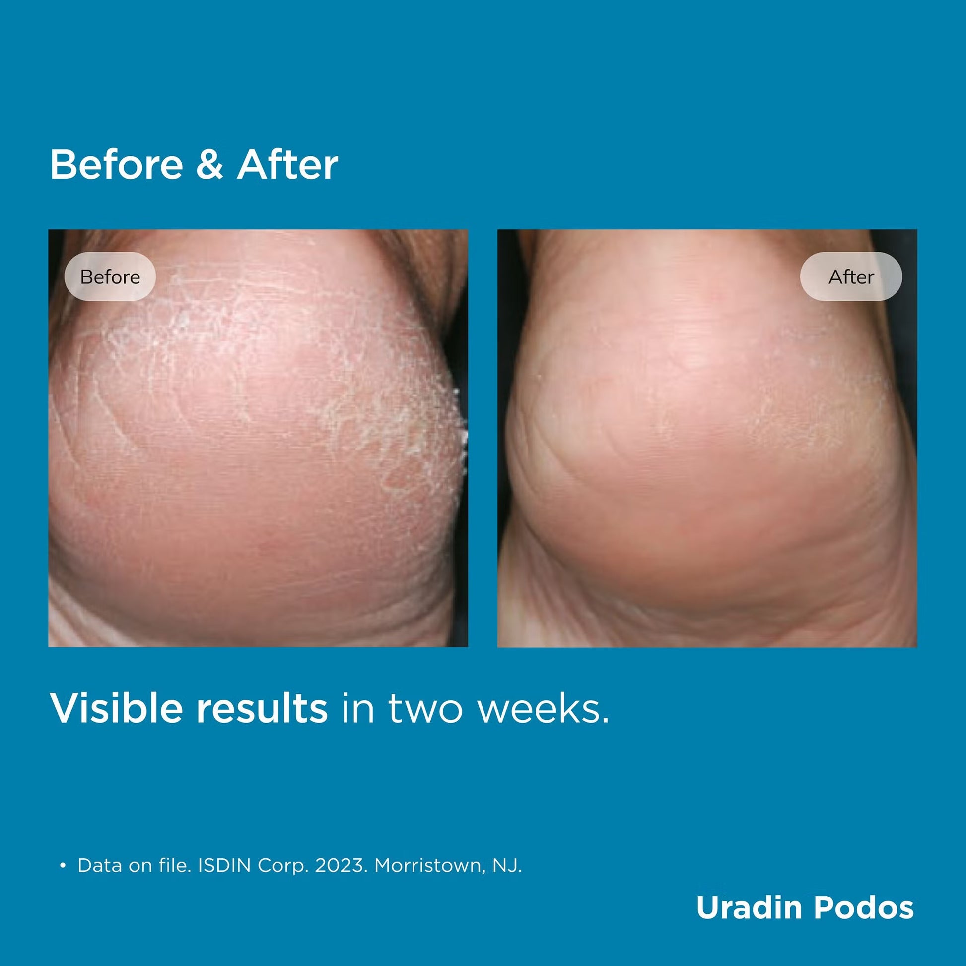 Before and after comparison of a foot with visible results in two weeks, branded as Uradin Podos.