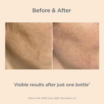 Before and after comparison of skin treatment showing visible results on a beige background.
