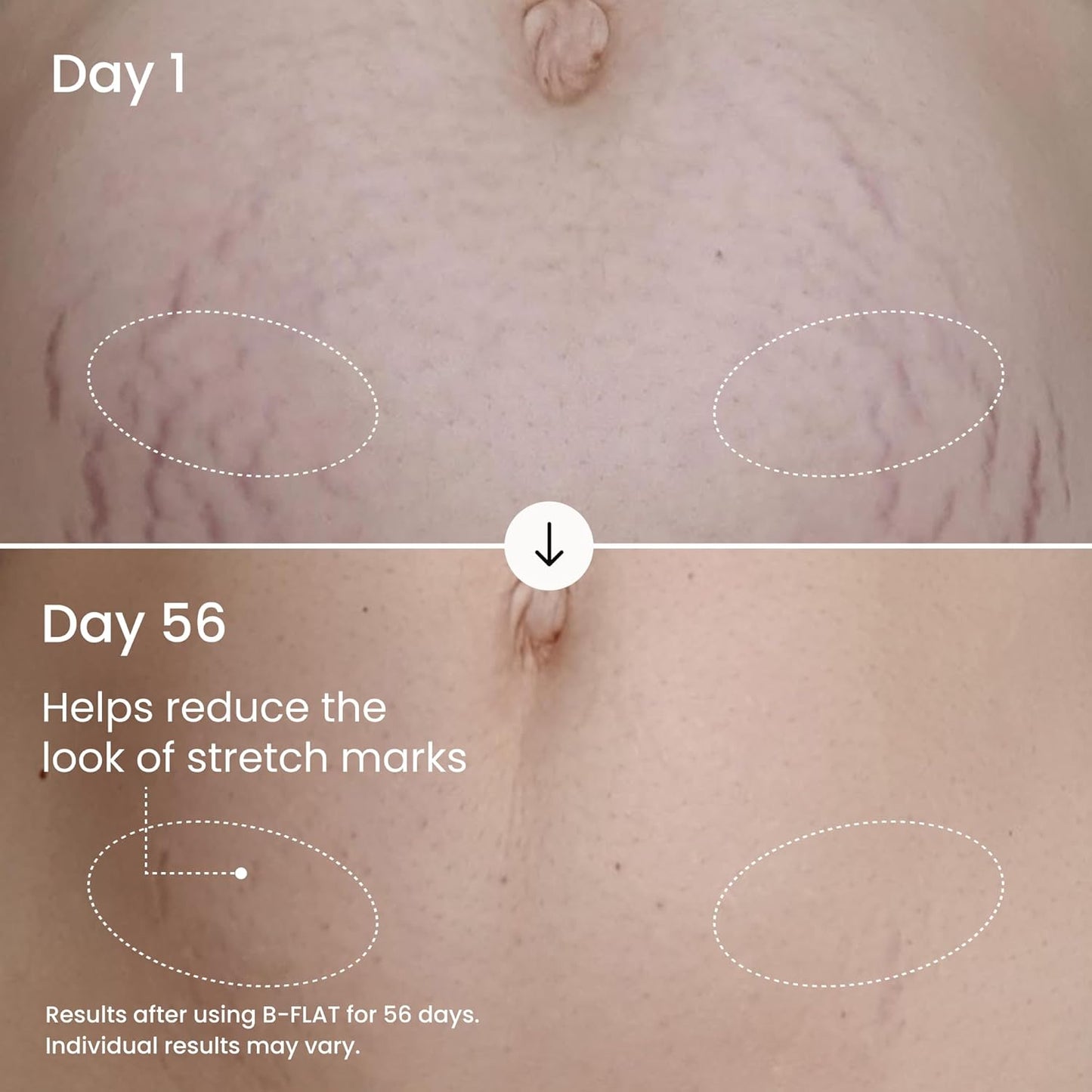 Before and after comparison of stretch marks on a person's skin, showing reduction over 56 days.