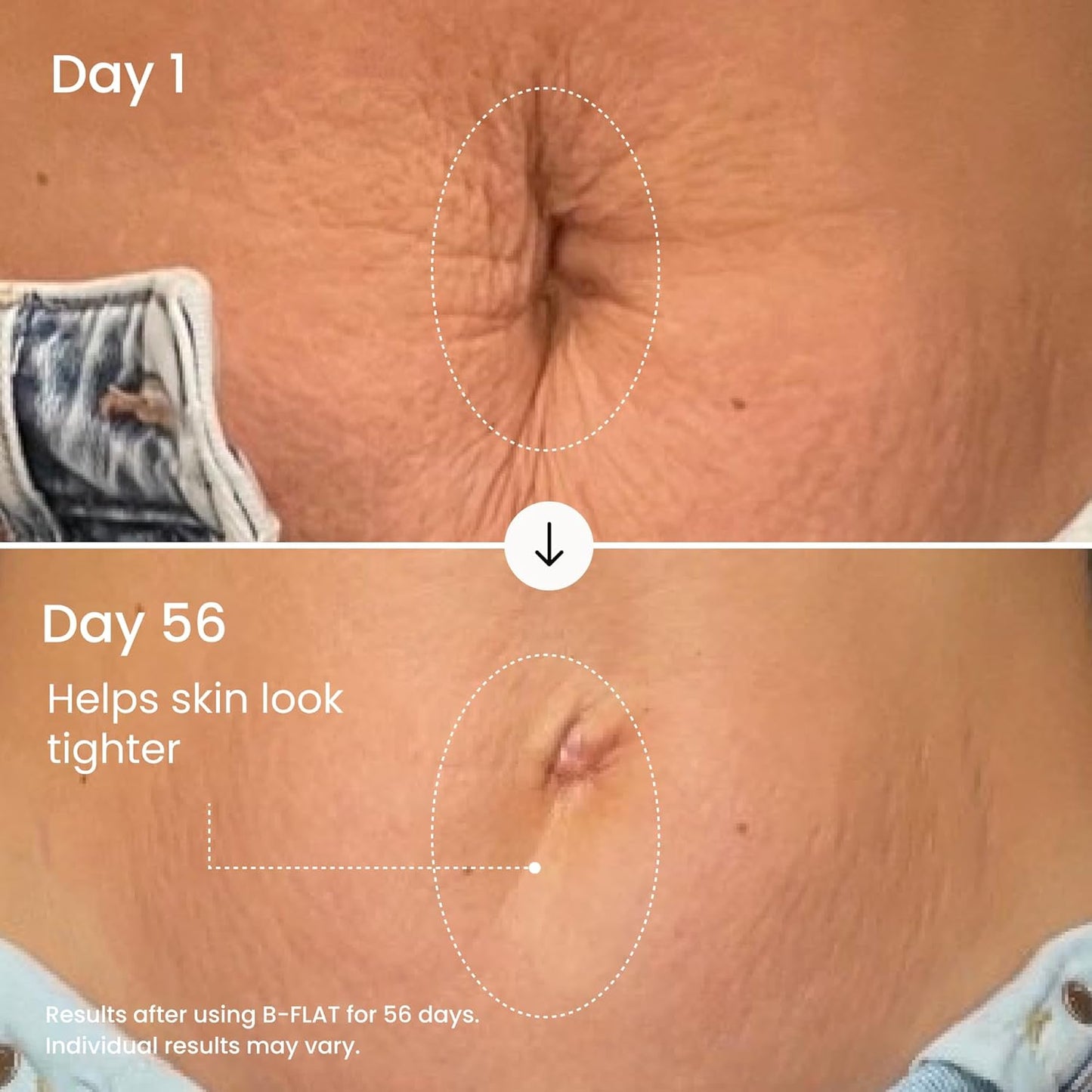 Before and after comparison of skin texture improvement over 56 days, showing a reduction in visible stretch marks.