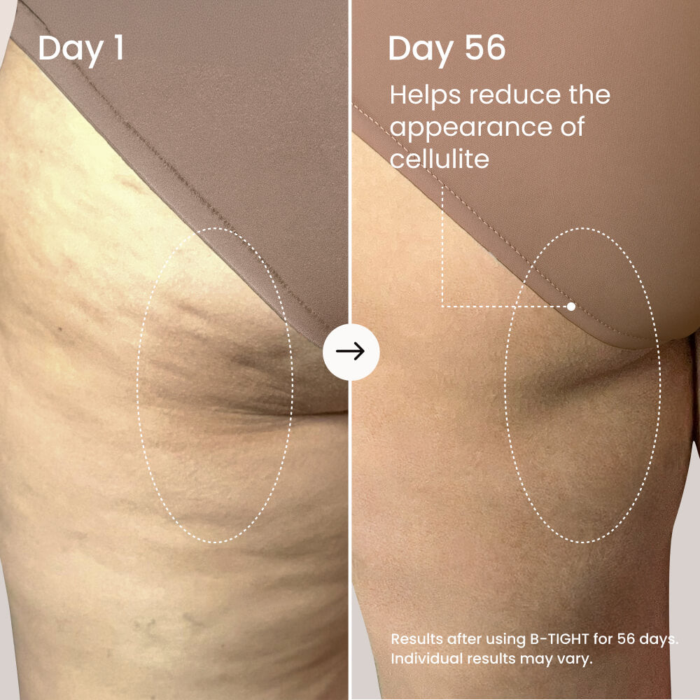 Before and after comparison of cellulite reduction on a person's leg using B-TIGHT product over 56 days.