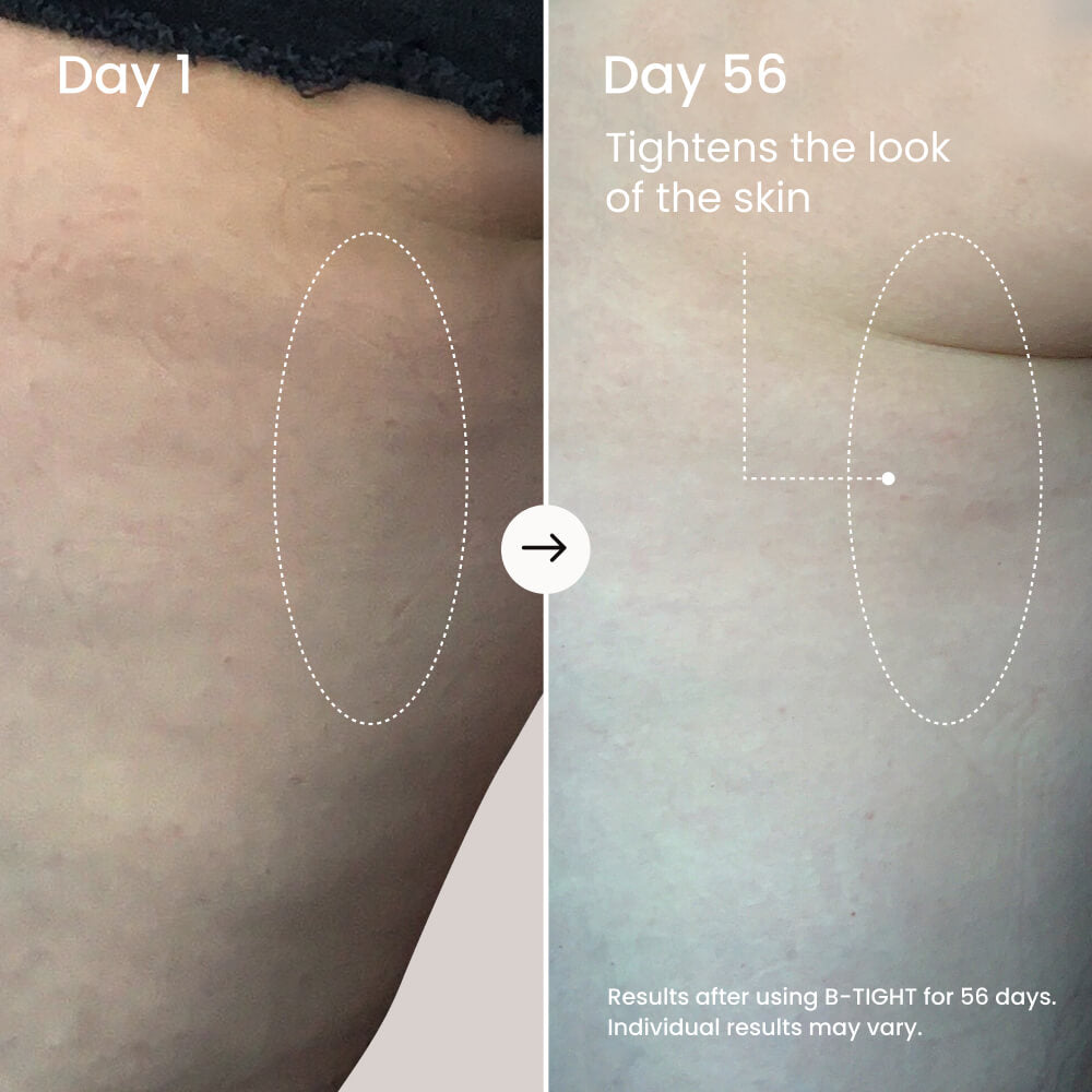 Before and after comparison of skin tightening treatment on Day 1 and Day 56.