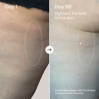 Before and after comparison of skin tightening treatment on Day 1 and Day 56.