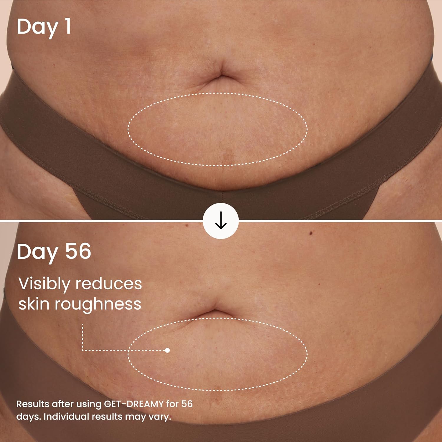 Before and after comparison of skin roughness reduction on a person's abdomen using GET DREAMY product.