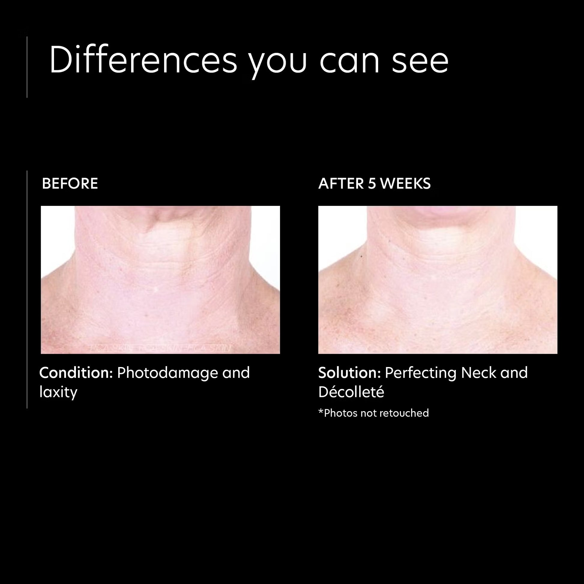Before and after comparison of neck and décolleté with photodamage and laxity, showing improvement after 5 weeks.